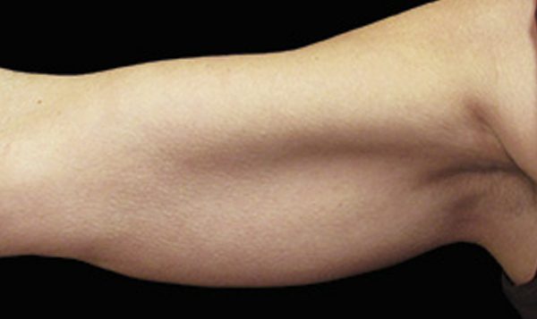 8 weeks after CoolSculpting® treatment Before