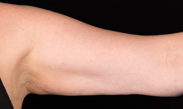 12 weeks after CoolSculpting® treatment  After