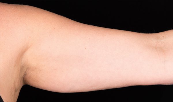 12 weeks after CoolSculpting® treatment  Before