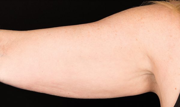 12 weeks after CoolSculpting® treatment  After