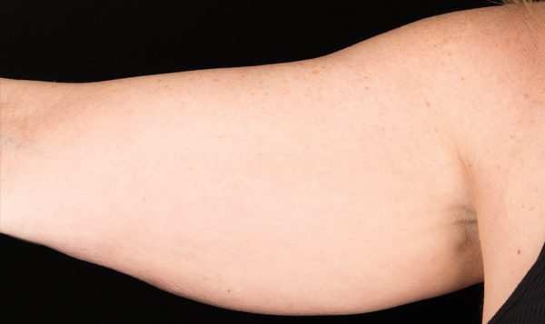12 weeks after CoolSculpting® treatment  Before