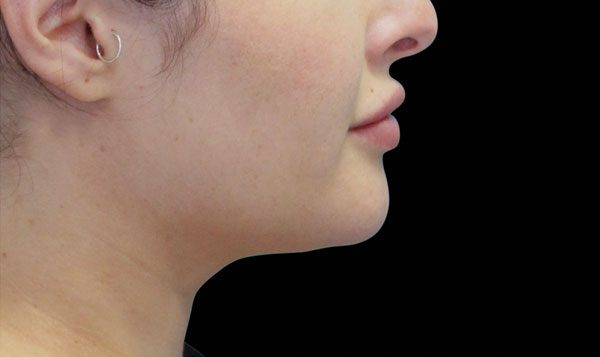 6 weeks after treatment After