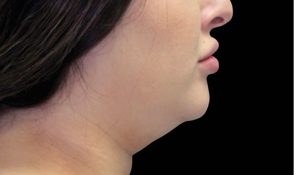 6 weeks after treatment Before