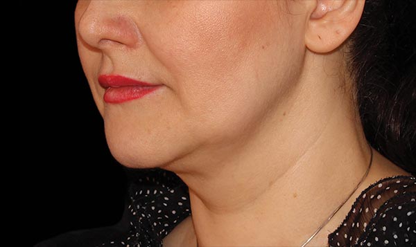 8 weeks after CoolSculpting® treatment  After