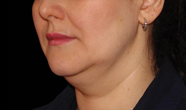 8 weeks after CoolSculpting® treatment  Before