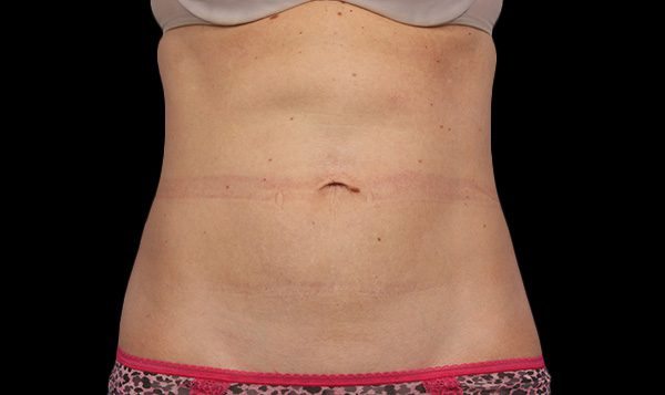 16 weeks after 2nd CoolSculpting® treatment  After