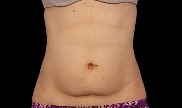 16 weeks after 2nd CoolSculpting® treatment  Before