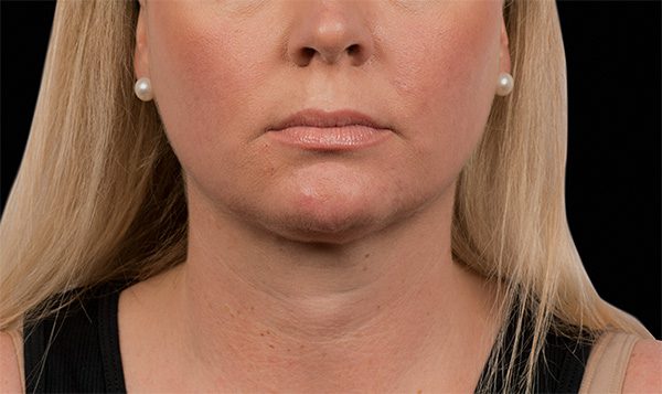 12 weeks after 2nd CoolSculpting® treatment After
