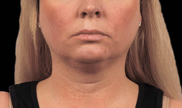 12 weeks after 2nd CoolSculpting® treatment Before