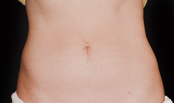 8 weeks after CoolSculpting® treatment  After