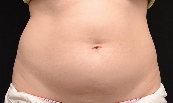 8 weeks after CoolSculpting® treatment  Before