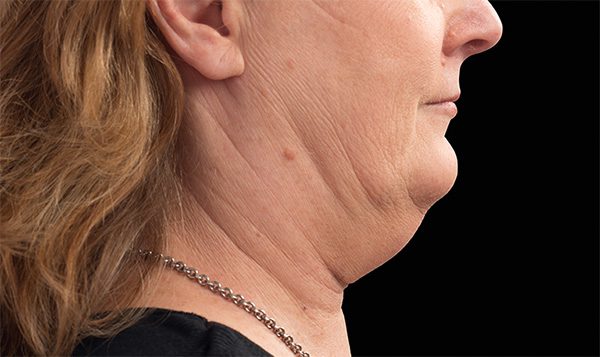 12 weeks after 2nd CoolSculpting® treatment Before